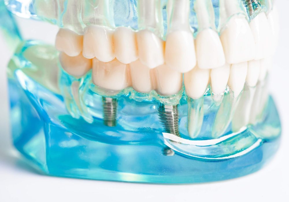 dental-implant-artificial-tooth-roots-into-jaw-r-2024-02-07-06-20-48-utc dental-implant-artificial-tooth-roots-into-jaw-r-2024-02-07-06-20-48-utc