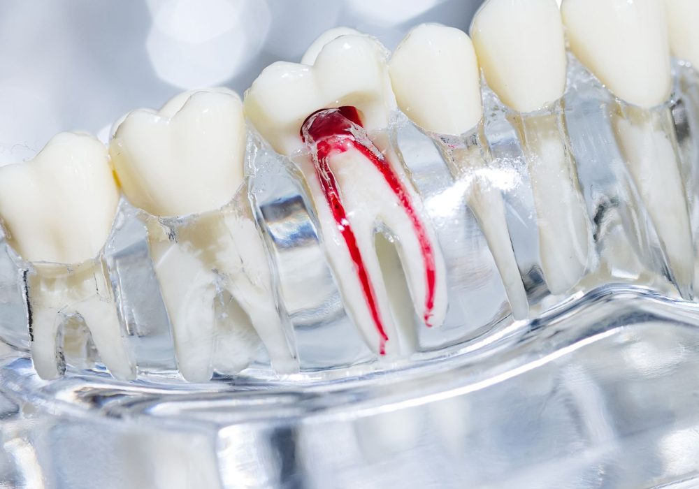 endodontia canal endodontia canal
